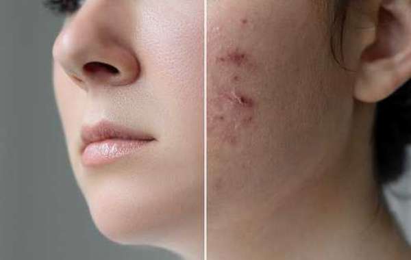 How To Cut Acne Out Of Your Life