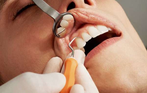 Implantes de Carga Inmediata en Barcelona Sonrisa Nueva en un Día