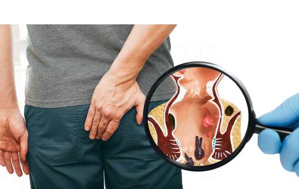 How to Choose the Best Piles Doctor in Kochi: A Complete Guide