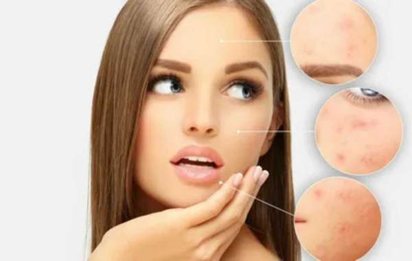 Acne Scars Treatment in Delhi: Best Solutions for Clear & Smooth Skin